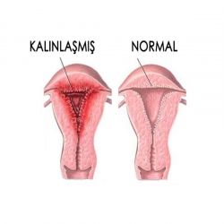 Rahim Duvarı Kalınlaşması - Endometrial Hiperplazi