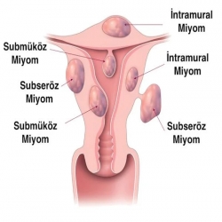 Miyom - Yumurtalık Kisti Ameliyatı