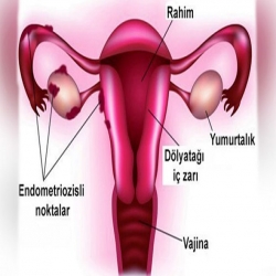 Çikolata Kisti - Endometriozis