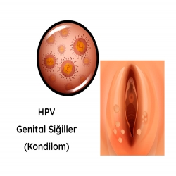 Genital Siğil - HPV Tiplendirme Testi